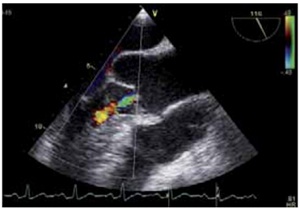 Exemple d’image (valve aortique)