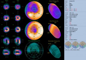 Anonyme IVA Polar Map (AC) Score